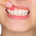 how long do cut gums take to heal