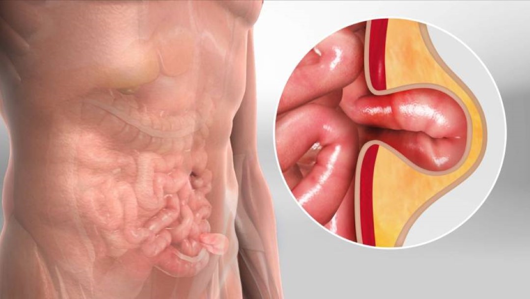 how to prevent hernia naturally