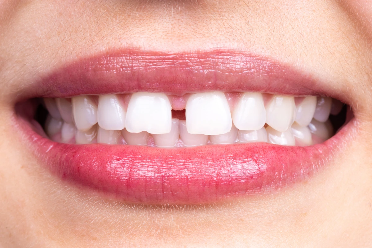 how to reduce the gap between teeth naturally
